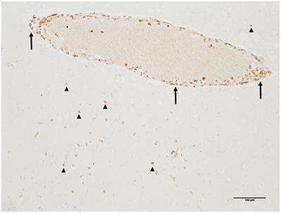 Brainstem Encephalitis With Low-Titer Acetylcholine Receptor Antibodies Mimicking Myasthenia Gravis